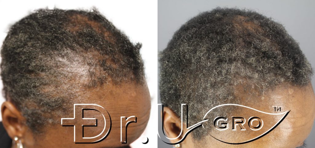 Within 3 months of starting Dr.UGro Gashee Diane's hair health had been restored in her edges