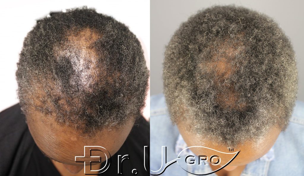 Within 3 months of starting Dr.UGro Gashee Diane's hair health was returning