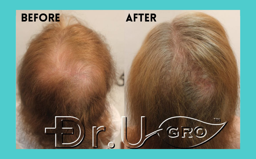 Before and after picture study results for hair growth following 4 months of Dr. UGro Gashee Topical Lotion, results from the published medical review on Dr.UGRO Gashee Lotion Topical for Hair Health.