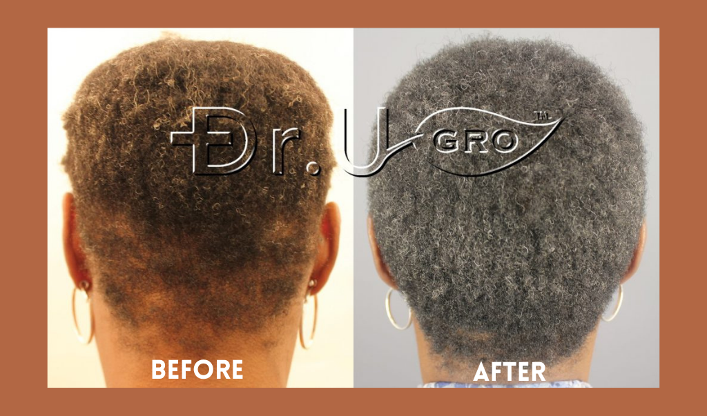 Diane Before and After several months of using Gashee All Natural Pomade*