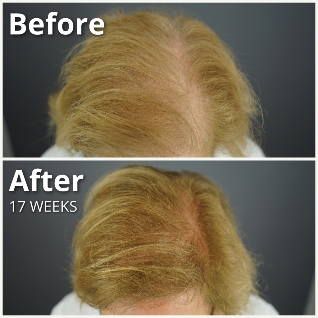 Dr. UGro Gashee Hair Growth Products: Natural Botanical Hair Lotion. Powered by Natural Ingredients. Before and After Picture Results after 17 weeks of product use..