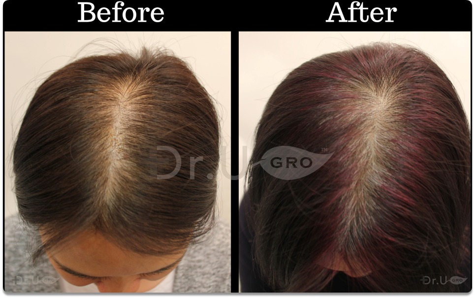 Dr.UGro GASHEE Natural Hair Growth Results with Dark Hair Using Natural Botanical Topical Lotion and Oral Hair Supplement for Hair Health. Through this angle, this doctor's new and improved hair length can be seen. Notice the new length, volume, and hair density she was able to acquire.