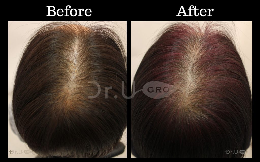 Dr.UGro GASHEE Natural Hair Growth Results with Dark Hair Using Natural Botanical Topical Lotion for Hair Health and Oral Hair Supplements. Notice the increased hair thickness, volume, and density.