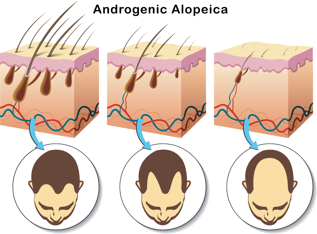 This graphic shows the process of miniaturization over time due to androgenic alopecia. Sensitive androgen receptors attract DHT molecules from the bloodstream, attaching the receptors to the hair follicles. Eugenol’s effect on androgen receptor activity has been researched, which is why it is important to critically appraise this literature before deciding to use eugenol for hair strength.