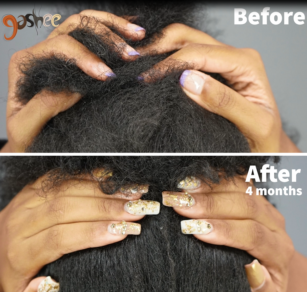 Before and after hair growth results of Dr. UGro Gashee Oral Supplements after 4 months of treatment.