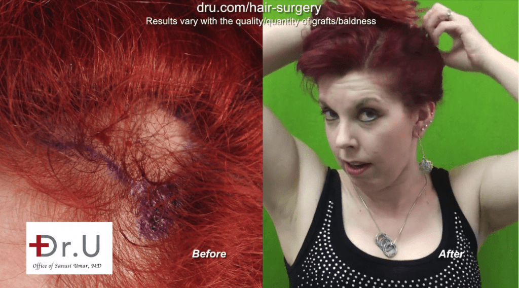 Hair transplant surgery helped this female patient recover from hair loss caused by traction alopecia