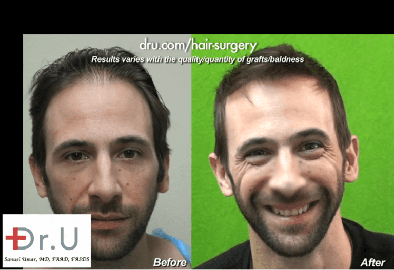 Los Angeles actor, Bernardo de Paula achieved an exceptionally natural-looking hairline after his hair transplant surgery