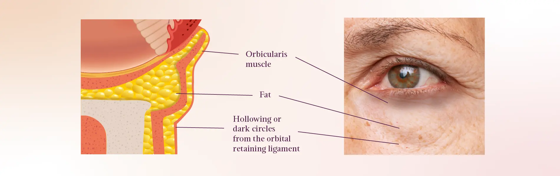 Anatomy Of The Under Eye Area