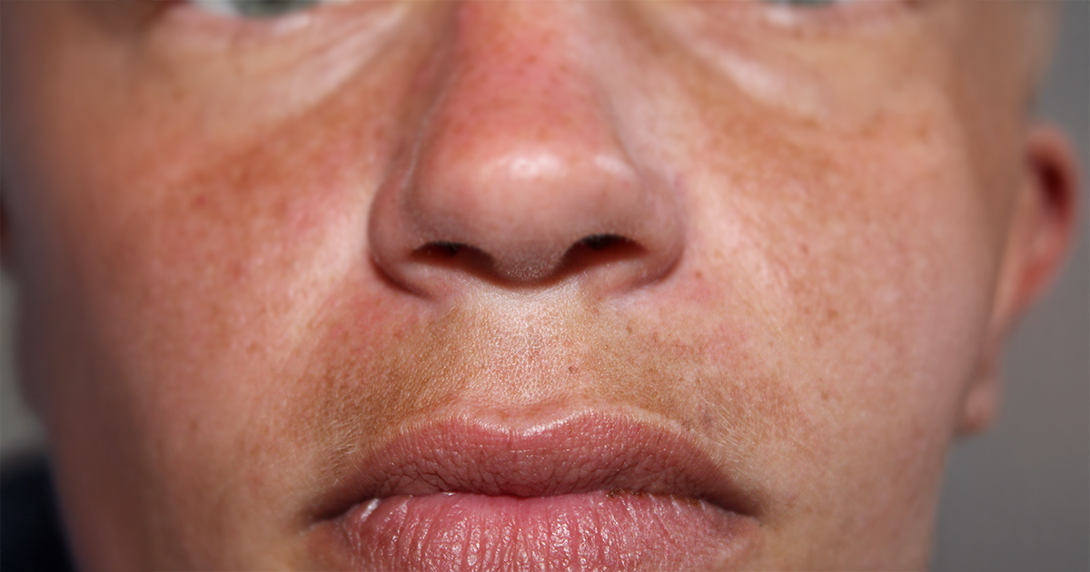 Dark spots During Pregnancy