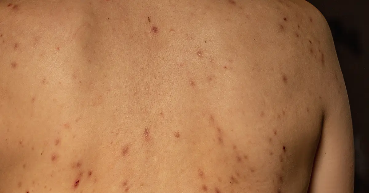 Difference Between Acne And Inflammatory Acne
