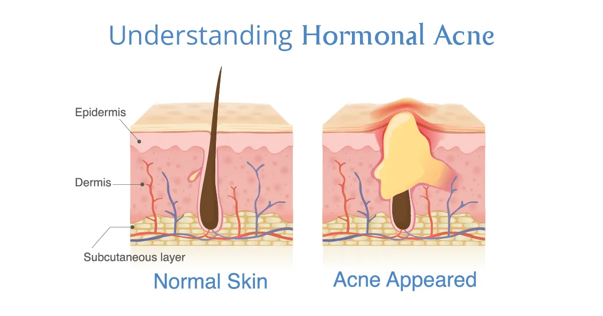 What Is Hormonal Acne?