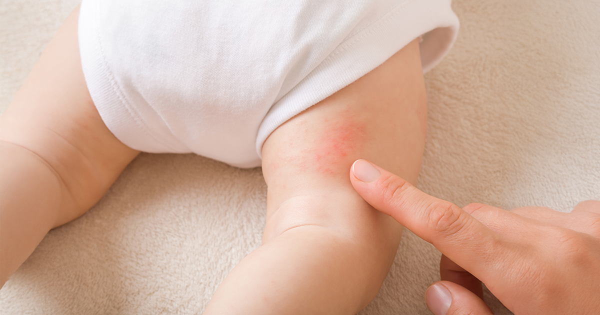 Hives