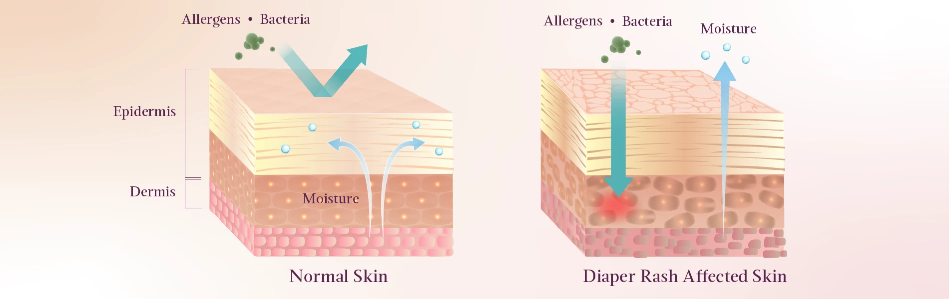 Beneath the Surface: How Diaper Rash Affects Skin Cells