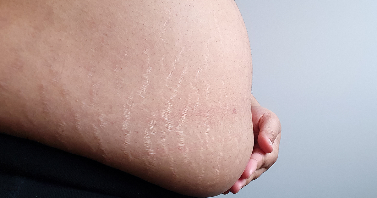 Stretch marks during Pregnancy