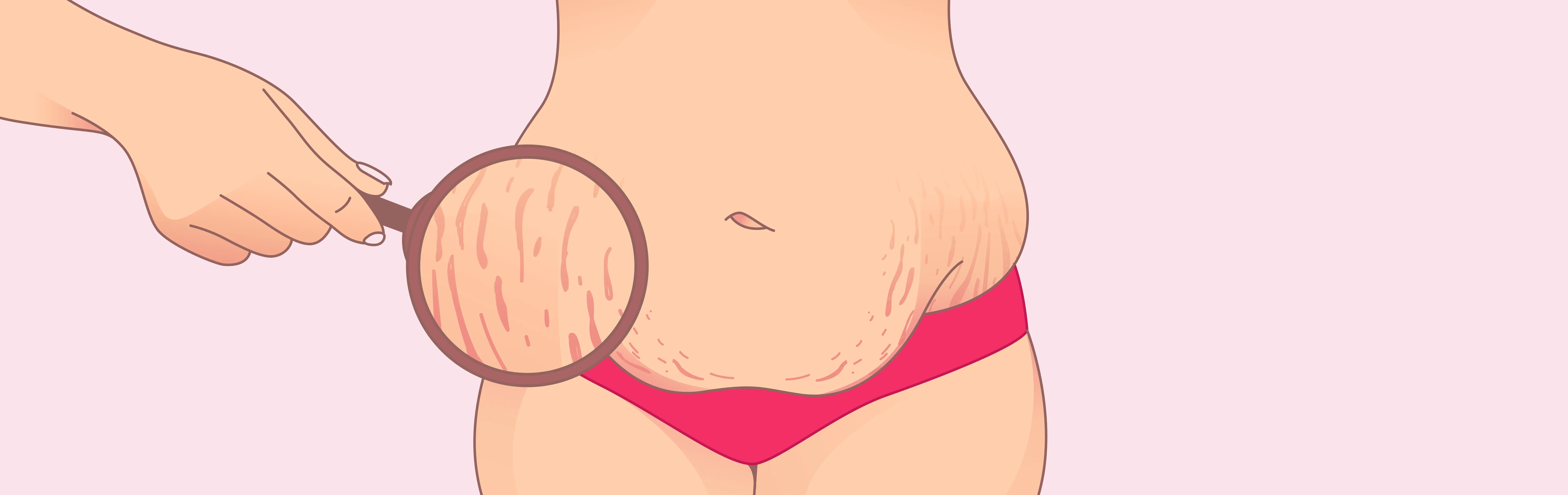 how to avoid stretch marks during pregnancy