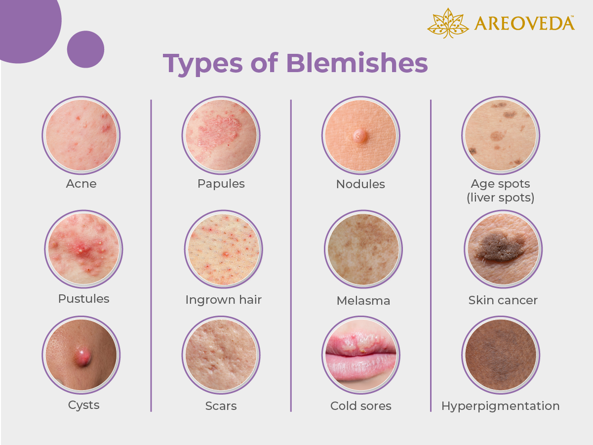 Types of Blemishes