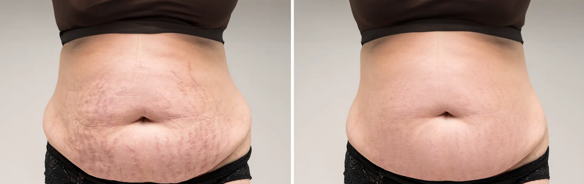 Types Of Stretch Marks During Pregnancy