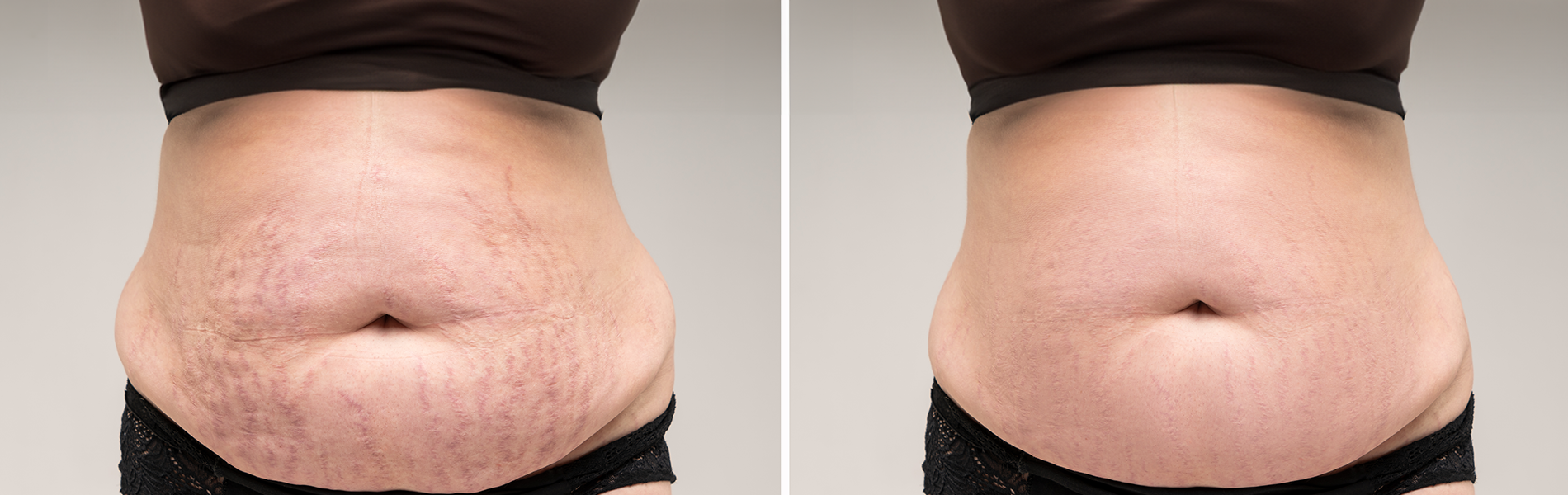 Types Of Stretch Marks During Pregnancy