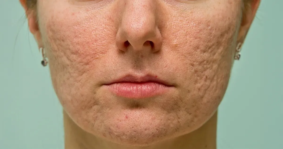 Understanding Acne Scars