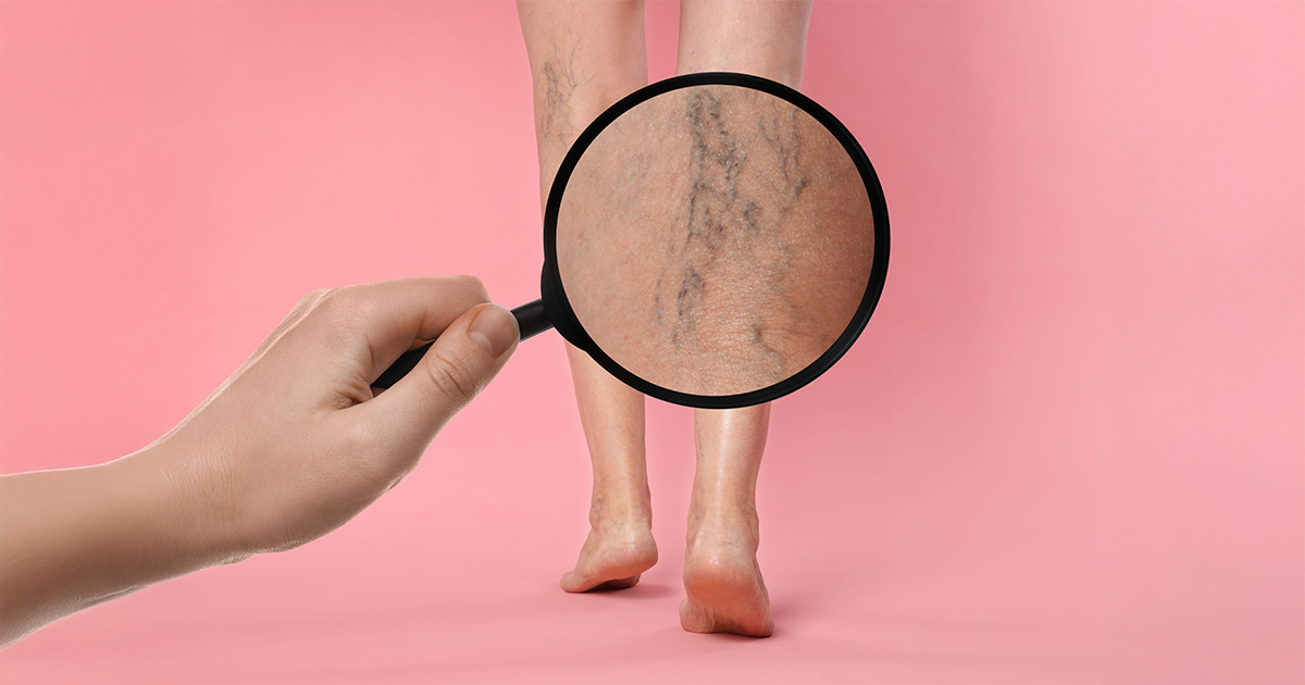 Varicose veins during Pregnancy