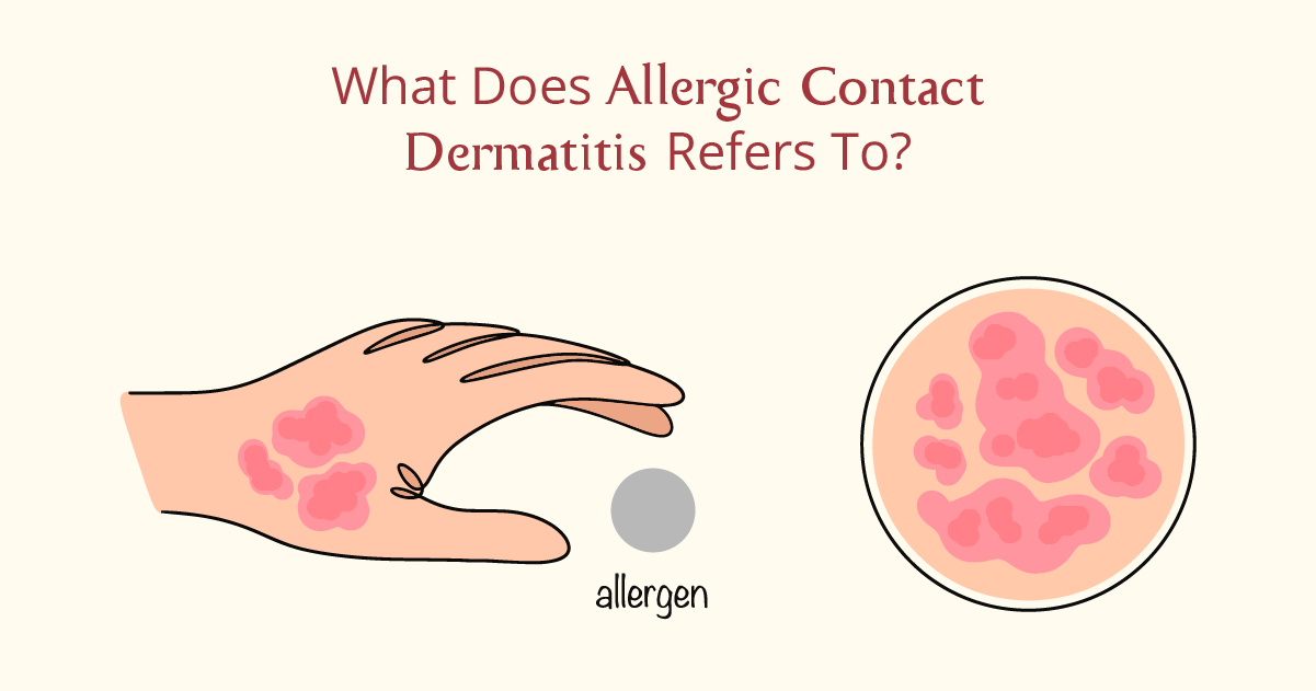 What Does Allergic Contact Dermatitis Refers To?