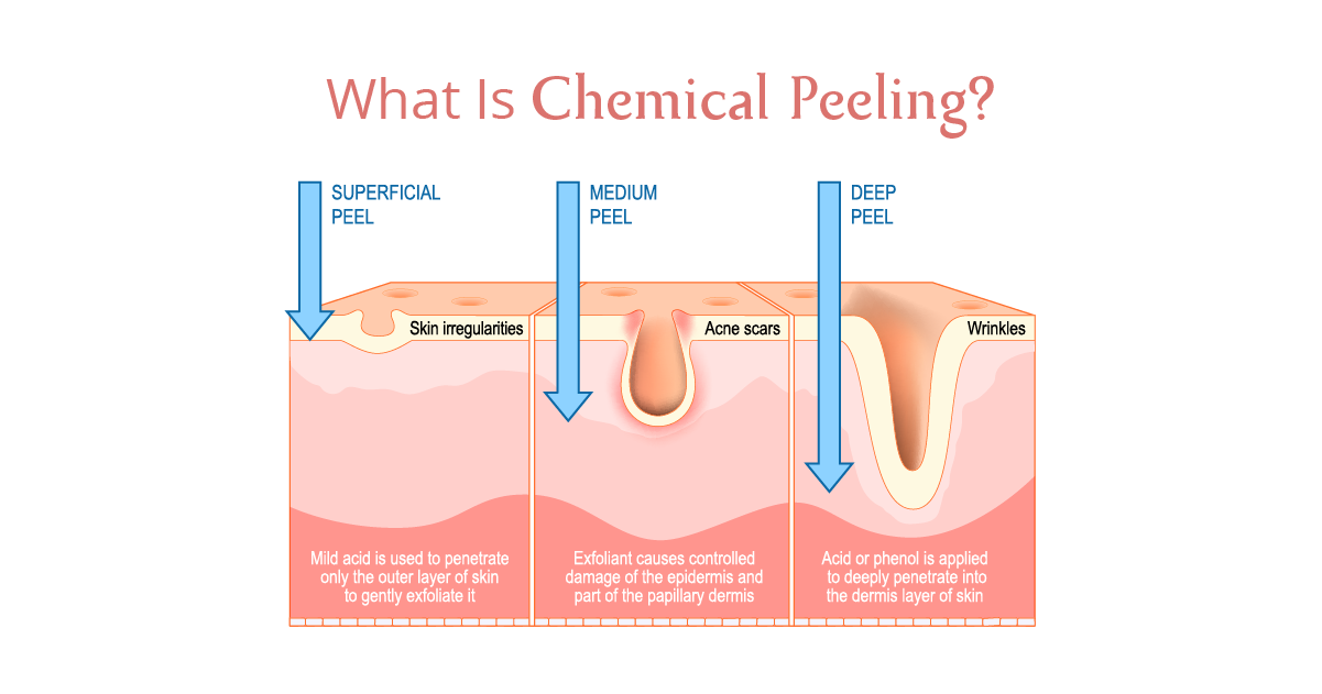 What Is Chemical Peeling?