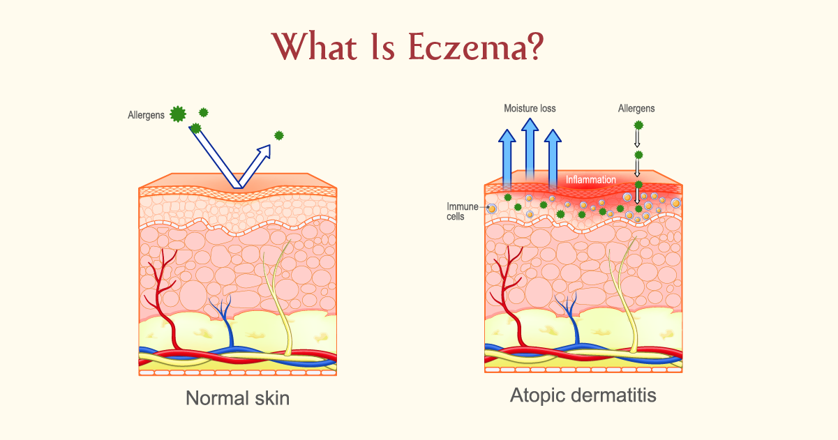 What Is Eczema?