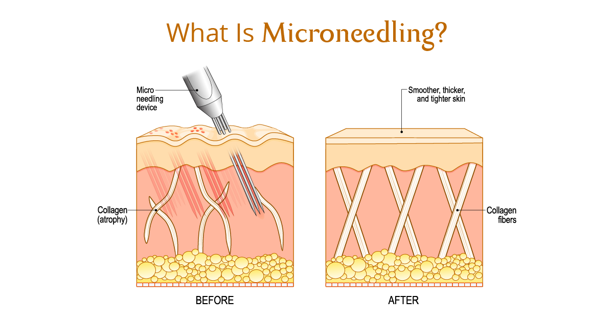 What Is Microneedling?
