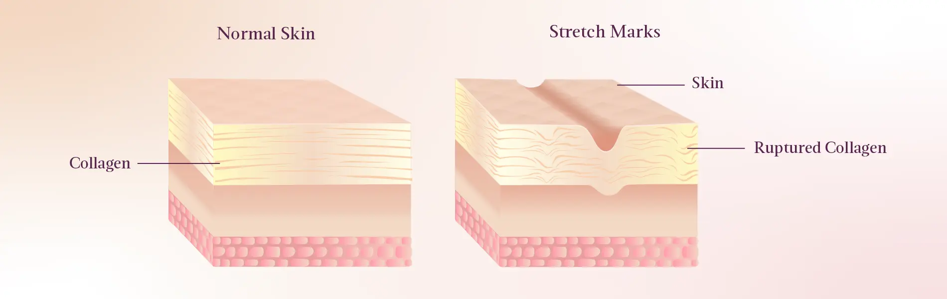 Causes of Stretch Marks During Pregnancy