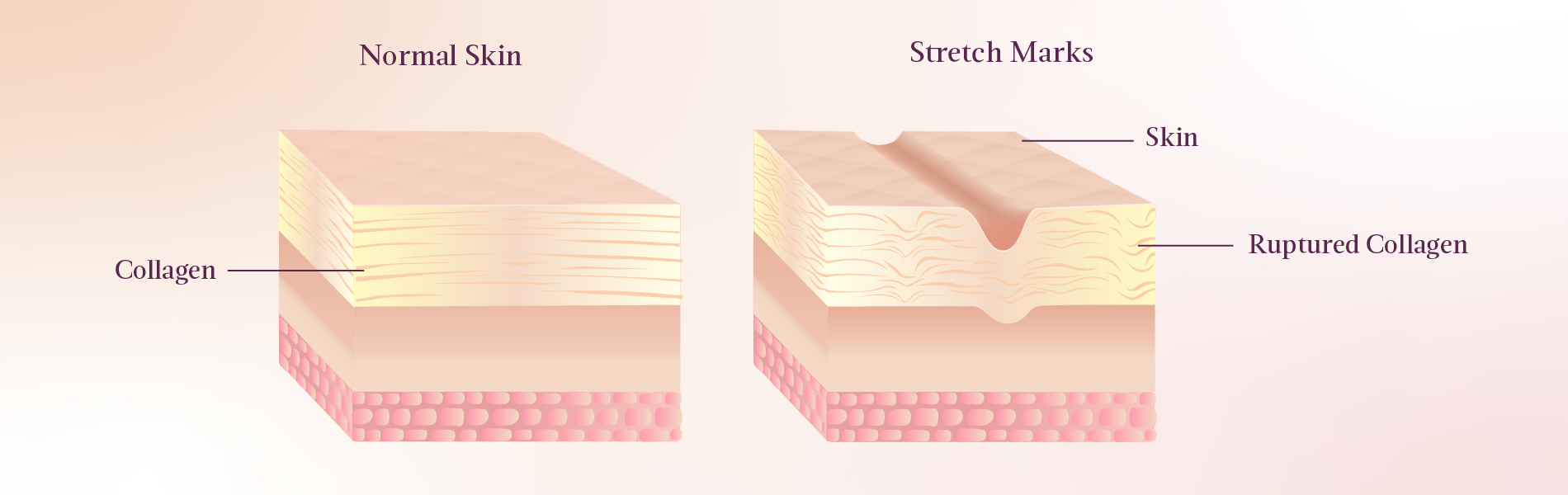 Causes of Stretch Marks During Pregnancy