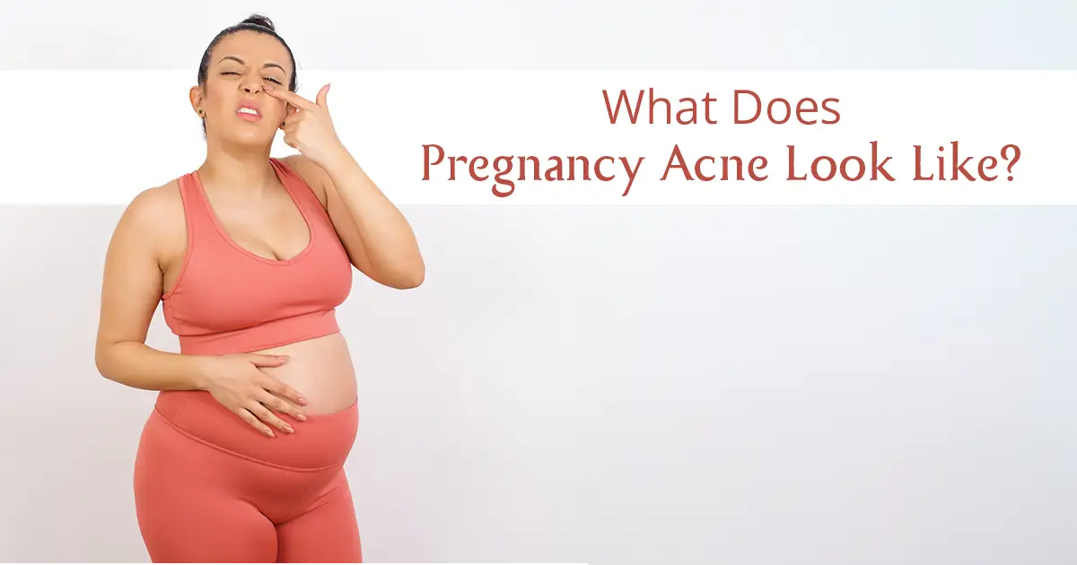 Is Hormonal Acne Caused By Pregnancy?