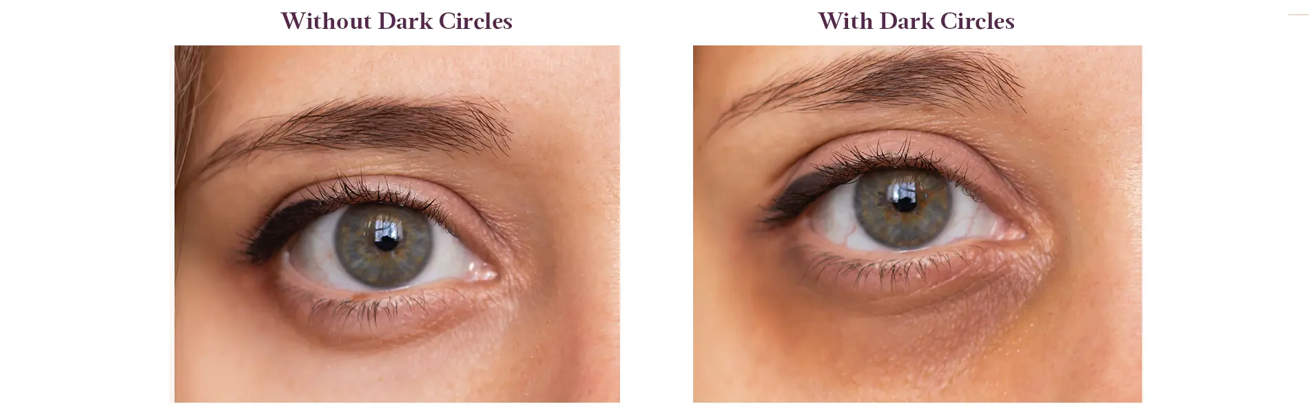 with & Without Dark Circles