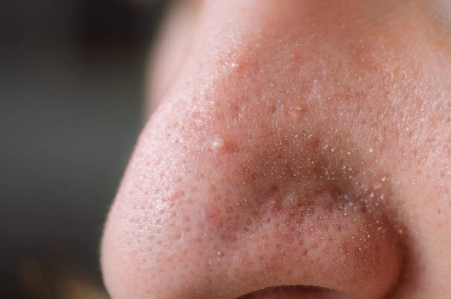 Clogged Pores