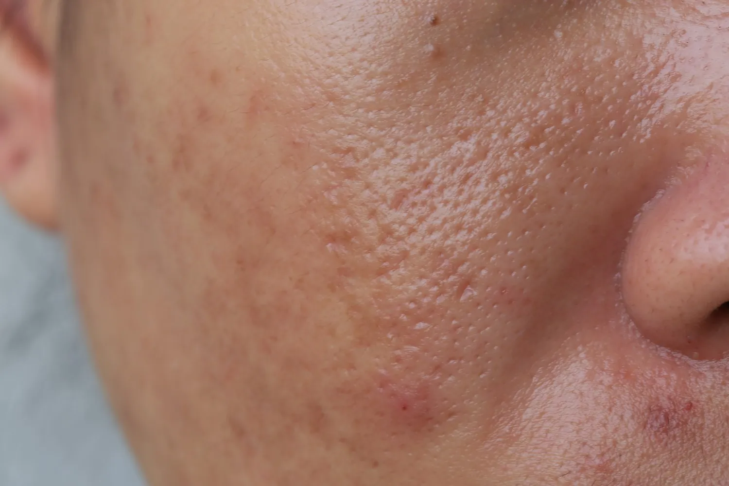 Large Pores