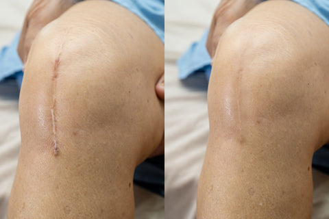 red light therapy before and after-knee scar recovery