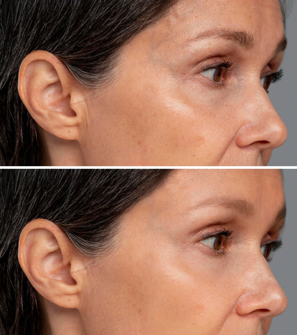 red light therapy before and after-antiaging