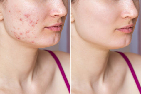 red light therapy before and after-acne