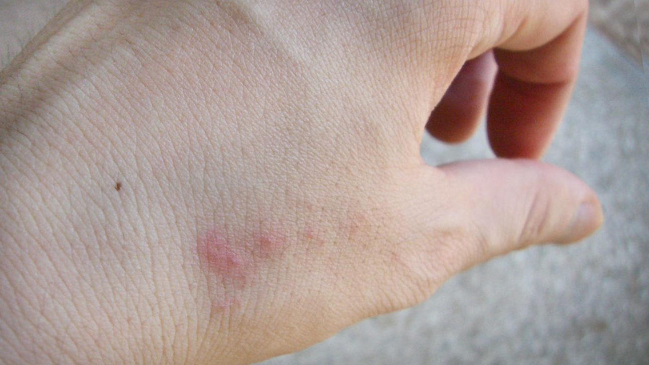 Bed bug bites: symptoms and treatments