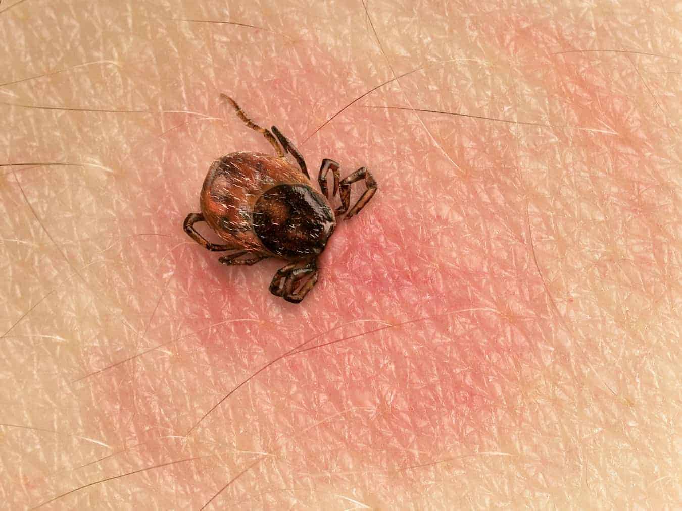 Tick bite symptoms and identification