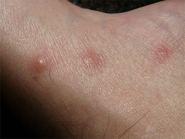 Flea bites vs bed bug bites