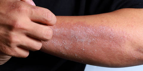 man scratching dry, flaky skin off of arm