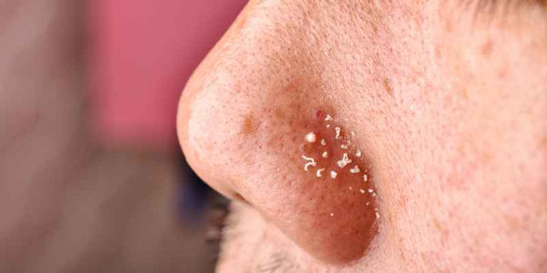 the smelly panda soap company pimples on somebodies nose showing oily skin